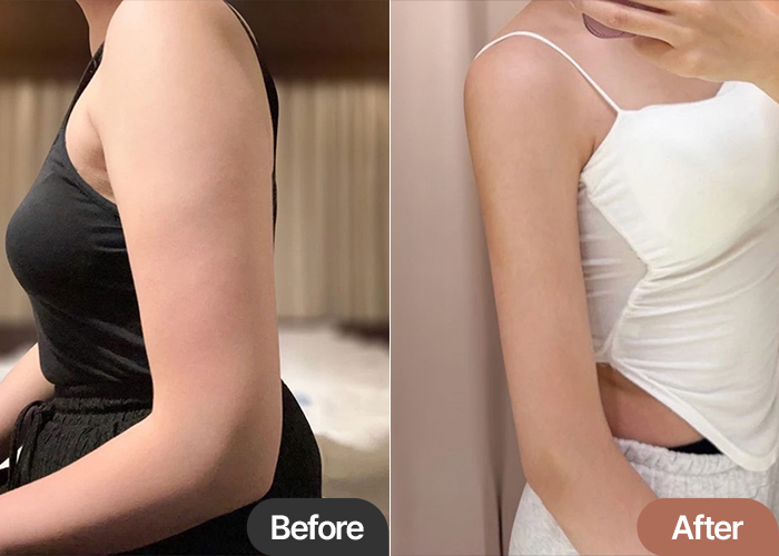 Arm Liposuction in Korea Before & After – Slim & Long Arm Line Transformation