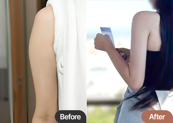 arm-liposuction-thumbnail-sujeopok