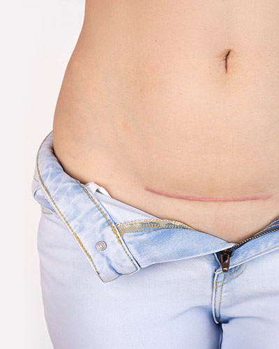 c-section-scar-rolling-01