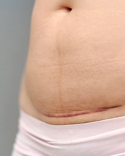 c-section-scar-rolling-02