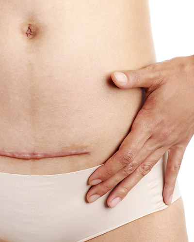 c-section-scar-rolling-03