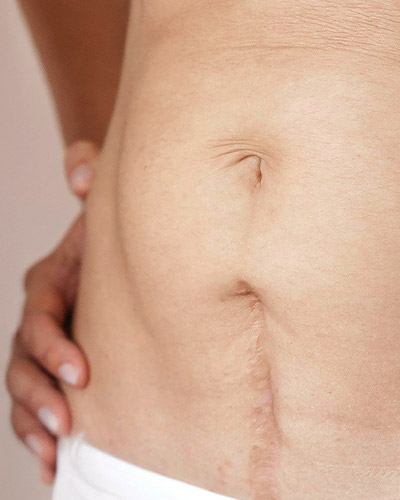 c-section-scar-rolling-04