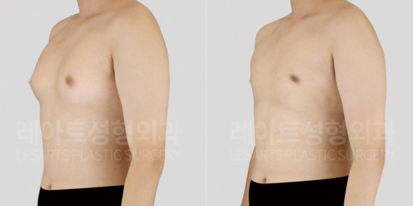 lesarts gynecomastia before and after