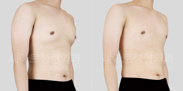 lesarts gynecomastia before and after