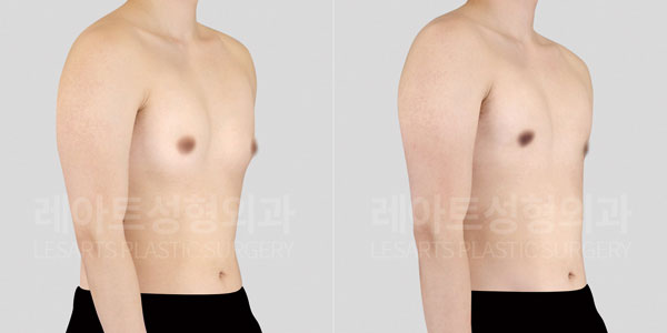 gynecomastia before and after