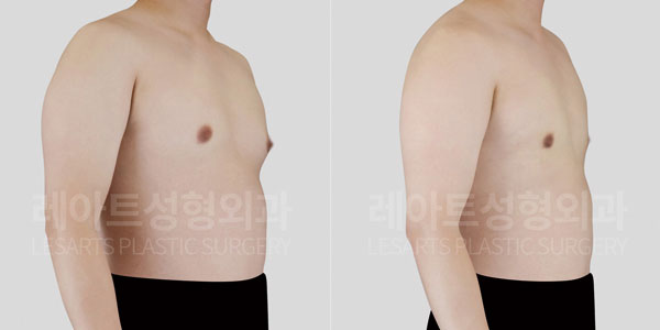 lesarts gynecomastia before and after