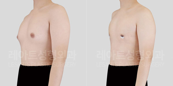 gynecomastia before and after