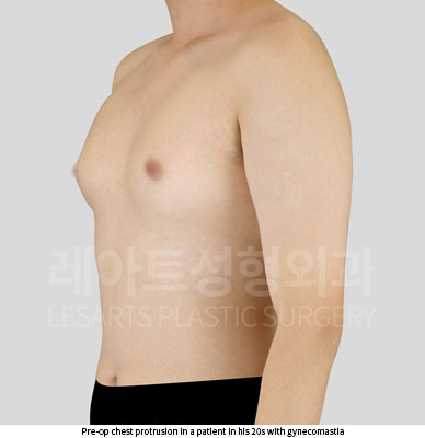 gynecomastia-02-01-251203