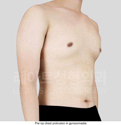 gynecomastia-02-01-251204