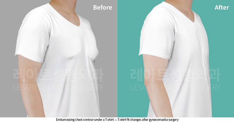 gynecomastia-02-01-260522