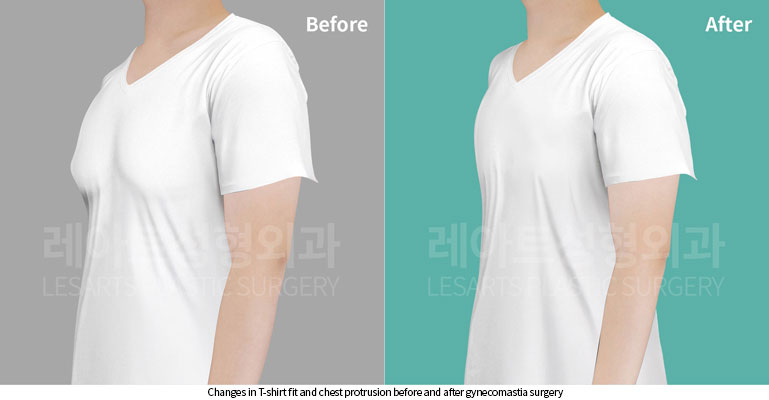 gynecomastia-02-01-260526