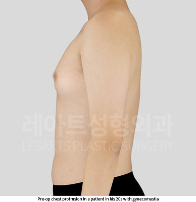 gynecomastia-02-02-251203