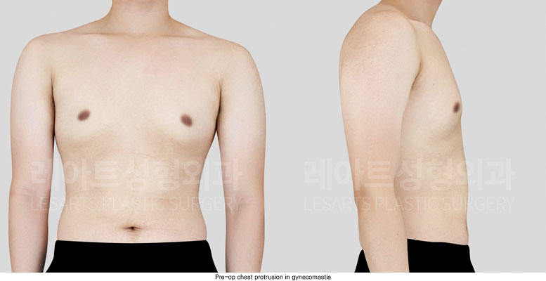 gynecomastia-02-02-251204