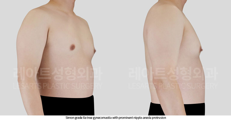 gynecomastia-02-02-260522