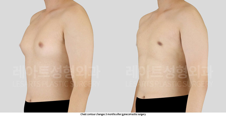 gynecomastia-02-03-251203
