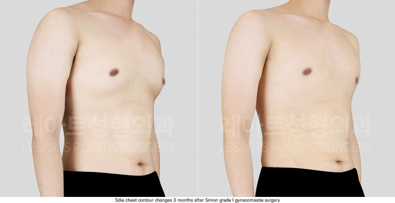gynecomastia-02-03-251204
