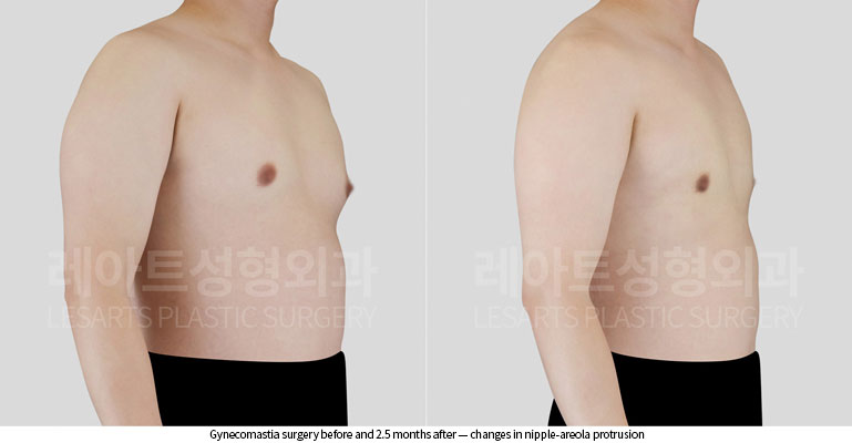 gynecomastia-02-03-260522