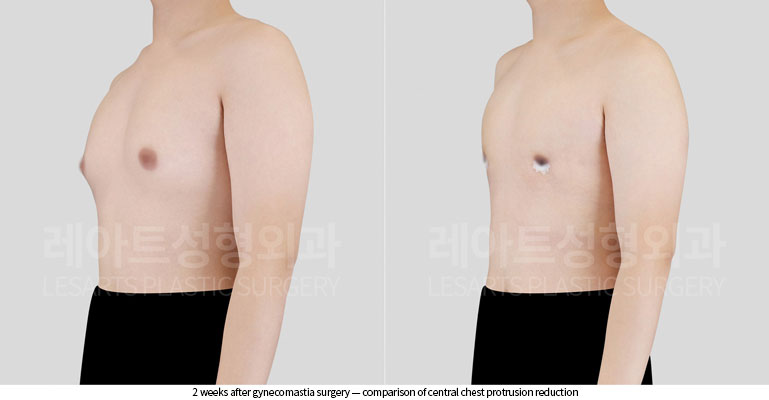 gynecomastia-02-03-260526