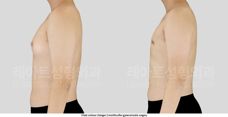 gynecomastia-02-04-251203