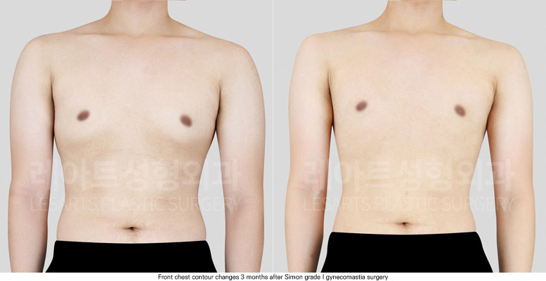 gynecomastia-02-04-251204