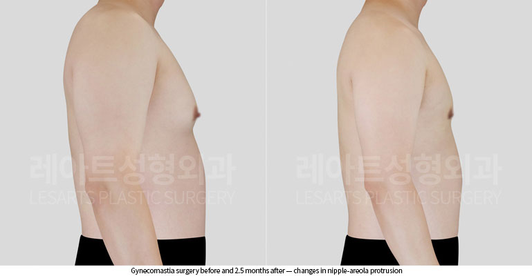 gynecomastia-02-04-260522