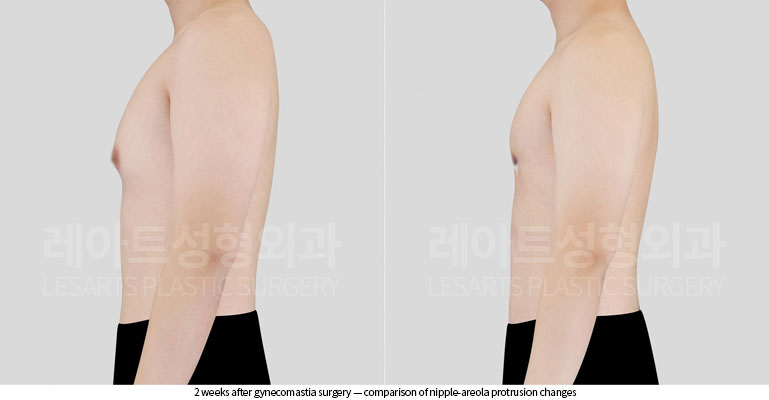 gynecomastia-02-04-260526