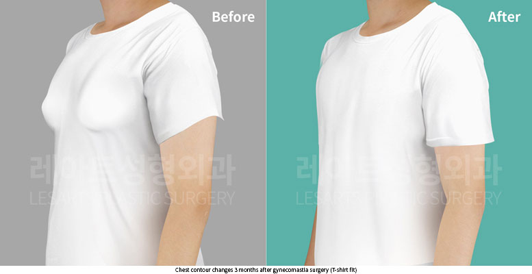 gynecomastia-02-05-251203