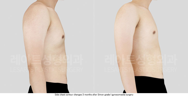 gynecomastia-02-05-251204