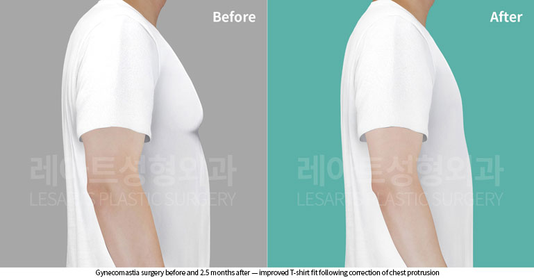 gynecomastia-02-05-260522