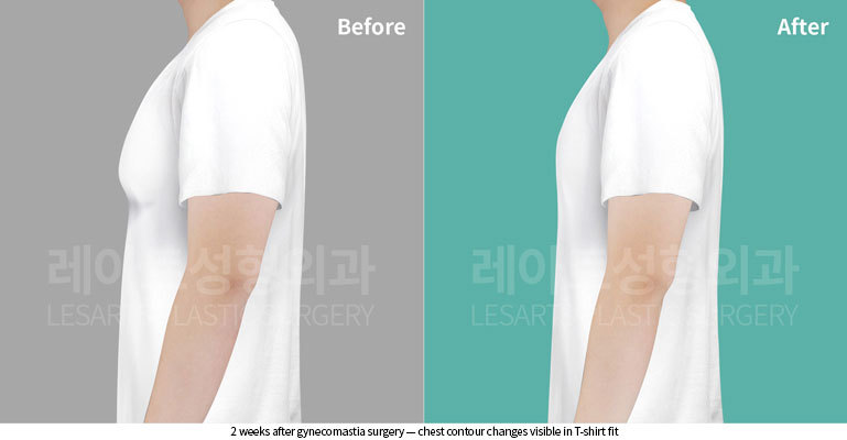 gynecomastia-02-05-260526