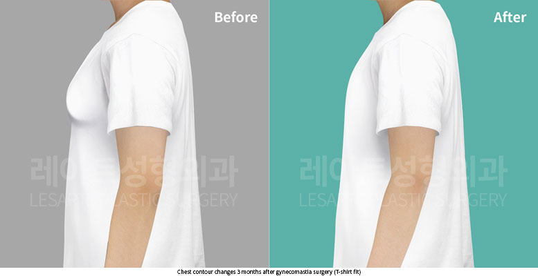 gynecomastia-02-06-251203