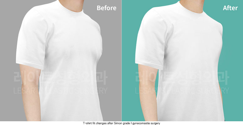 gynecomastia-02-06-251204