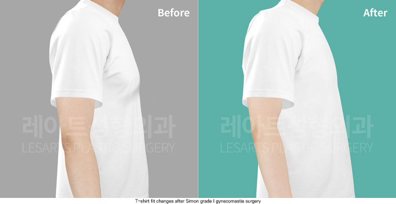 gynecomastia-02-07-251204