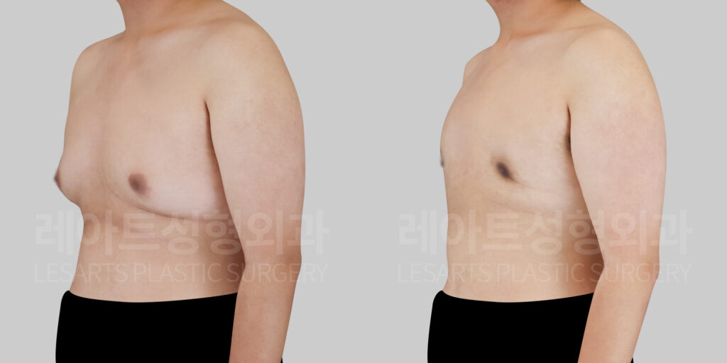 gynecomastia before and after(45 degree)