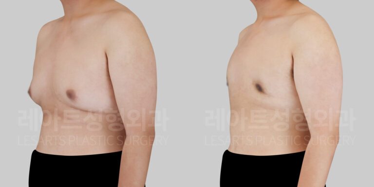 gynecomastia before and after(45 degree)