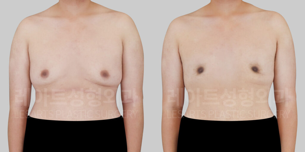 gynecomastia before and after(front view)