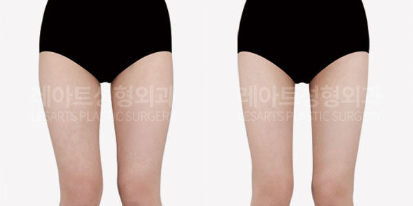thigh liposuction before and after-lesarts plastic surgery
