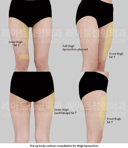 thigh-liposuction-02-01-251204