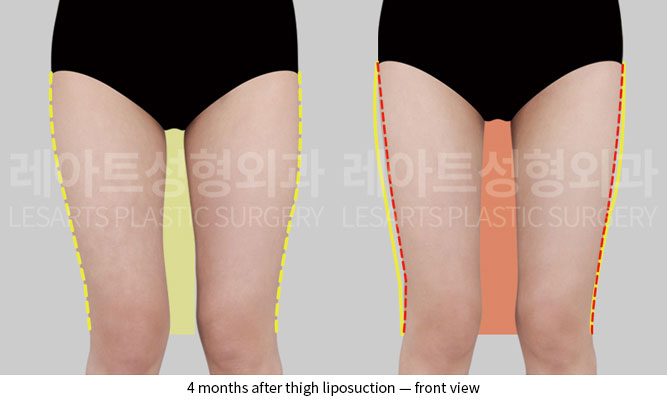 thigh-liposuction-02-02-251204