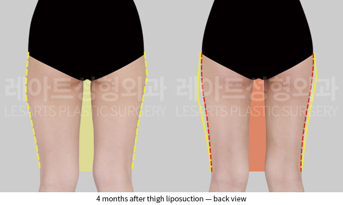 thigh-liposuction-02-03-251204