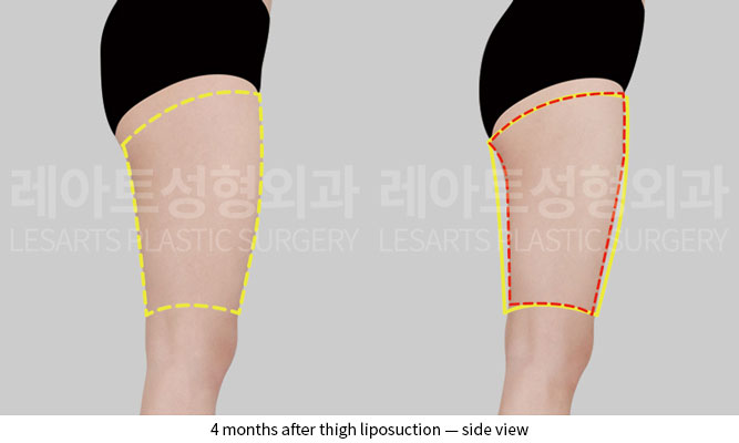 thigh-liposuction-02-04-251204