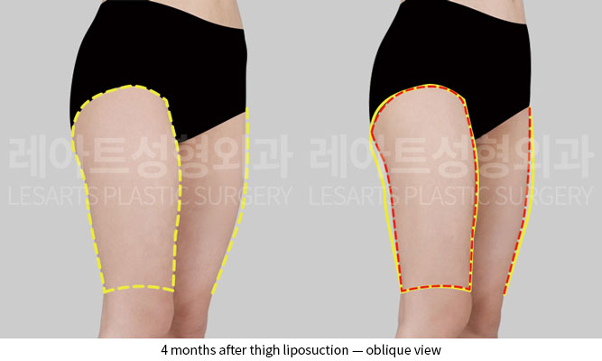 thigh-liposuction-02-05-251204