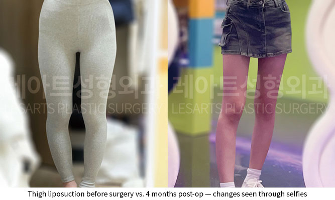 thigh-liposuction-02-06-251204