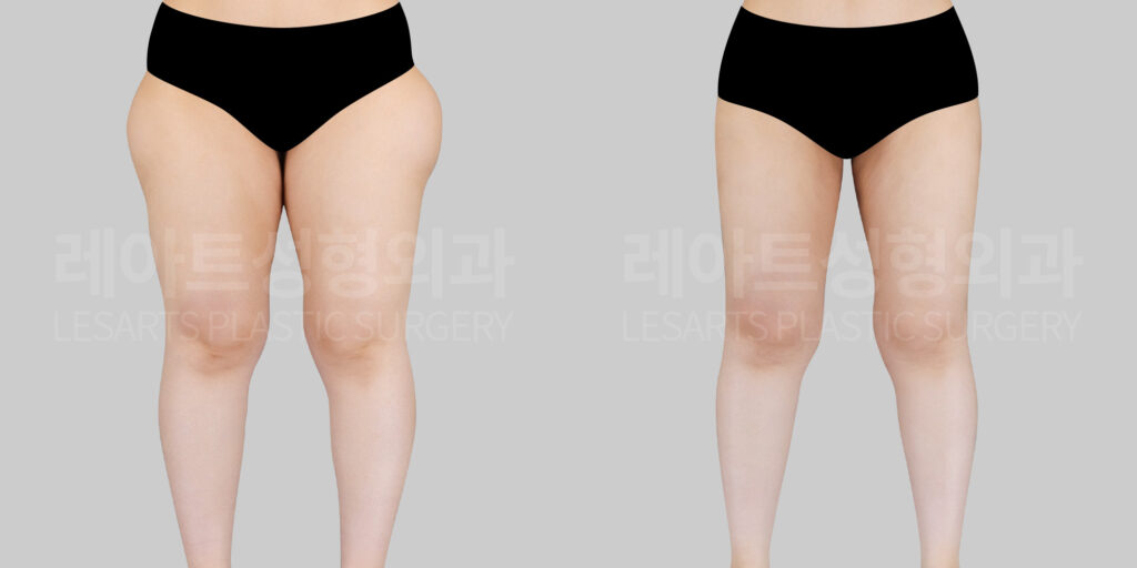 lesarts thigh liposuction