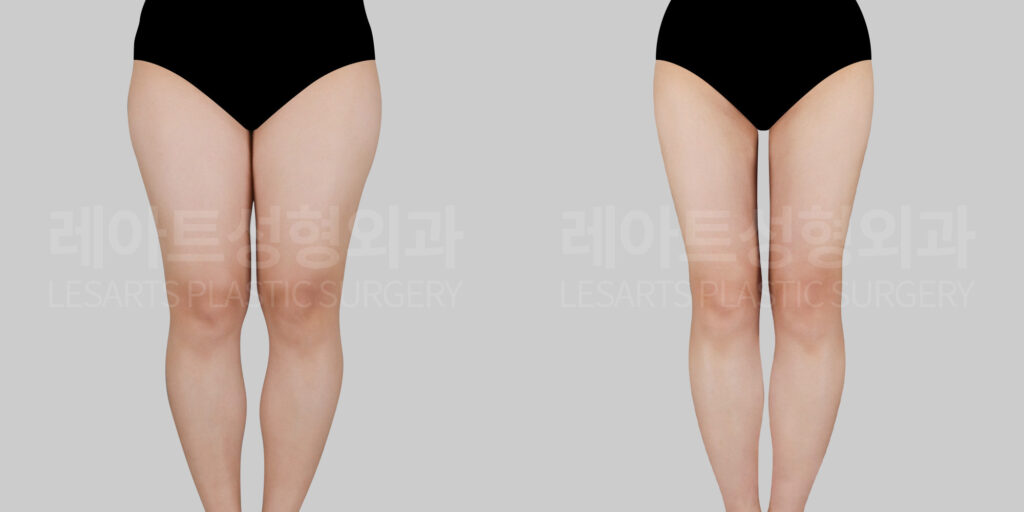 thigh-liposuction-30518-bna-front