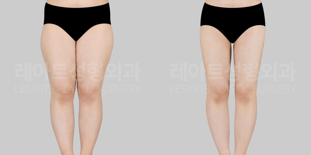 thigh liposuction before and after