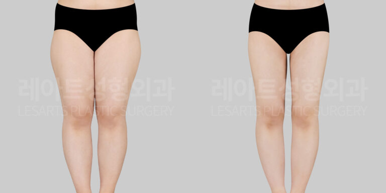 thigh liposuction before and after