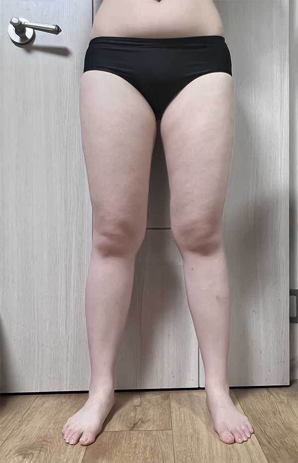 thigh-liposuction-gyongttwin-before