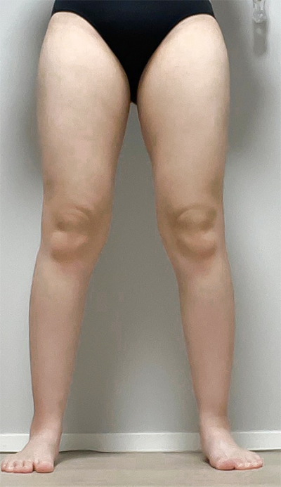 thigh-liposuction-ruiya-before