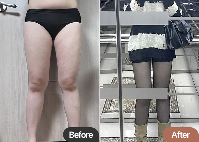 thigh-liposuction-thumbnail-gyongttwin